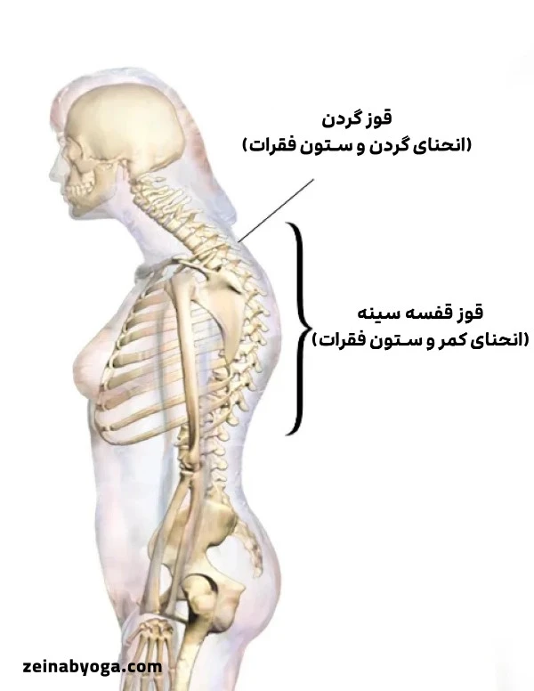 درمان قوز پشت